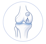 Cartilage Transplantation1