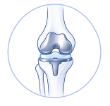 Knee Replacement