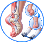 Pes Equinovarus Treatment