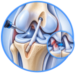 acl treatment