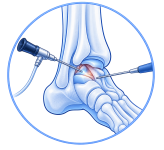 ankle arthroscopy