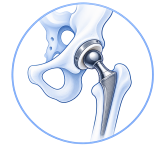 hip replacement