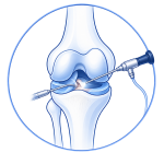 knee artroscopy
