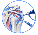 shoulder arthroscopy